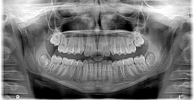 Dental Core Training - How to Apply xray x ray gd2e3c5d1b 640