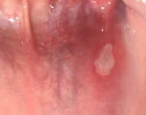 640px Mouthulcer