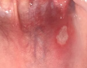 Oral Ulceration 640px Mouthulcer