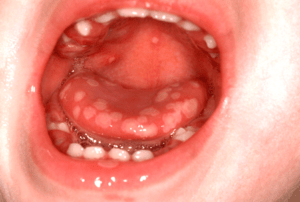 Primary Herpetic Stomatitis